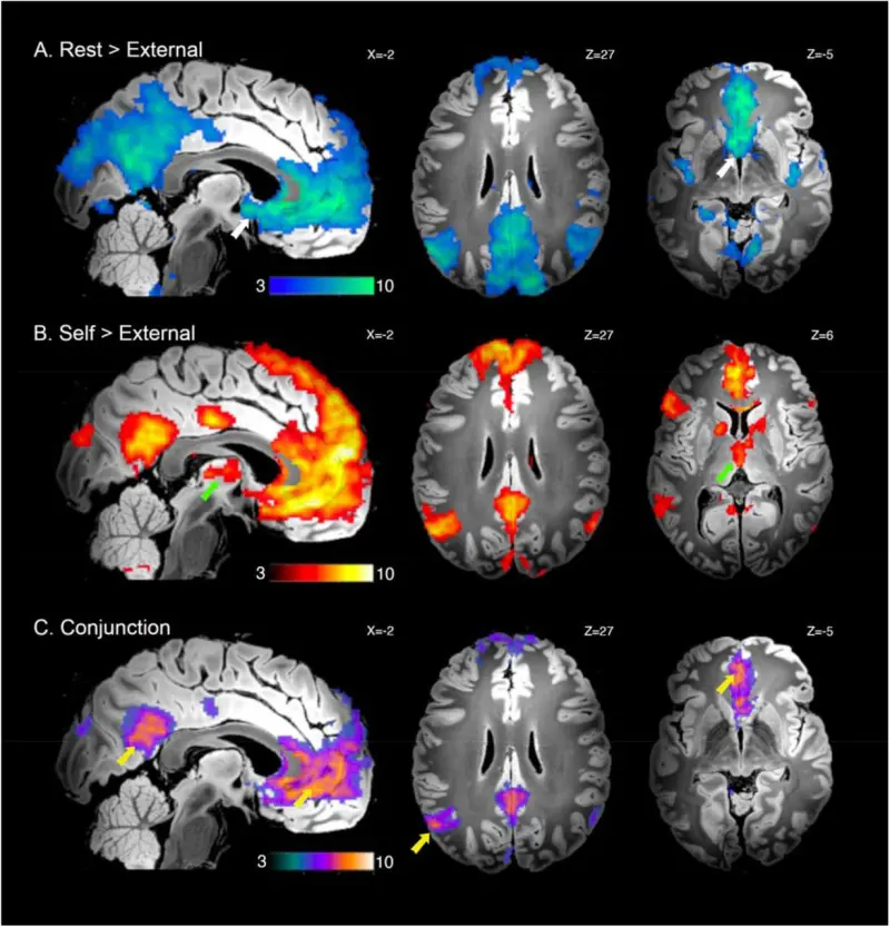 Vielight photobiomodulation trancranienne cognition