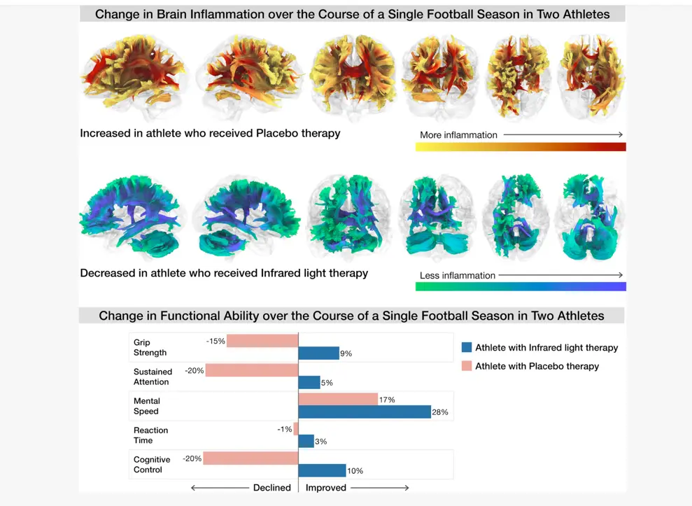 DTI-Imaging-Utah-v1.jpg (1) Photobiomodulation cérébrale transcranienne commotion et traumatisme cranien