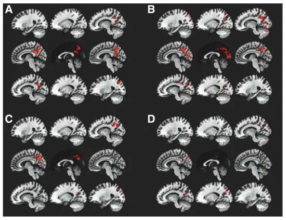 Perfusion cérébrale photobiomodulation alzheimer
