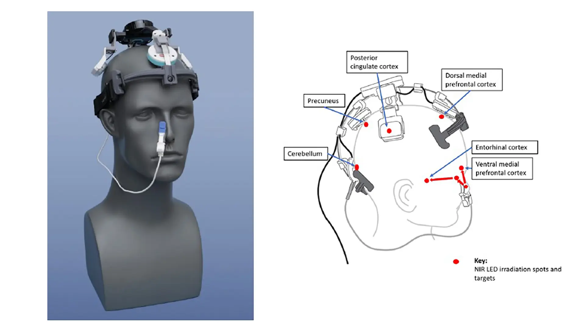 Photobiomodulation transcrânienne intranasale pour le brouillard cérébrale covid long